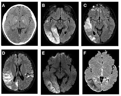 Inherited Metabolic Causes of Stroke in Children: Mechanisms, Types, and Management